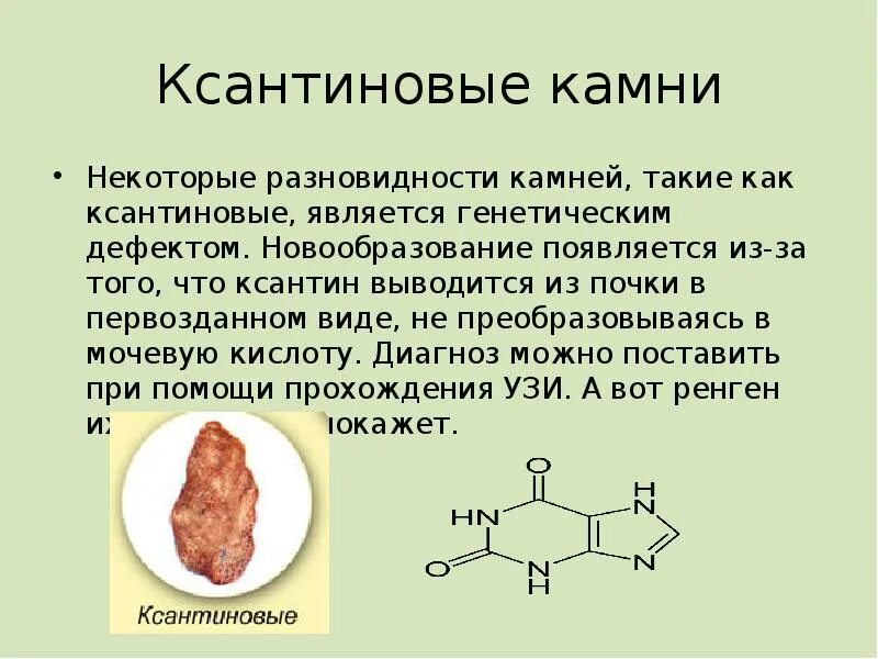 Ксантиновые камни в почках. Почему образуются ксантиновые камни. ксантинурия биохимия. ксантиновые камни в почках причины образования.