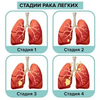 Как распознать рак на ранней стадии симптомы