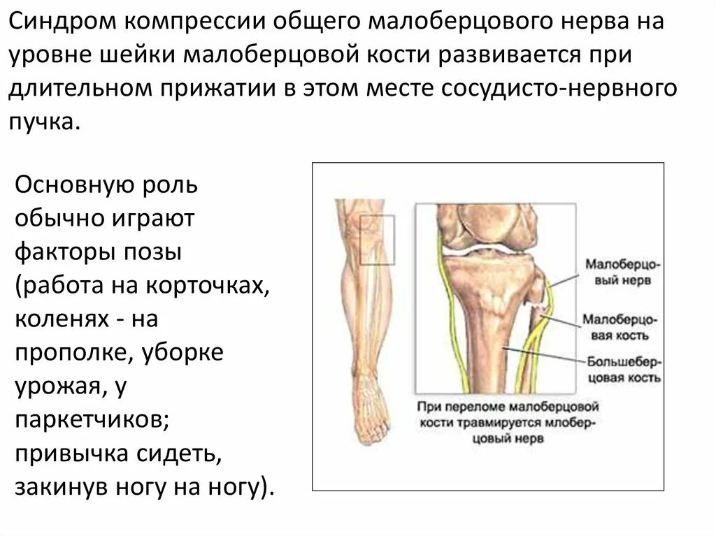 Аксональное поражение малоберцового нерва. Нейропатии большеберцового малоберцового нерва. Компрессии общего малоберцового нерва. Медиальный малоберцовый нерв. Аксональное поражение малоберцового нерва что это.