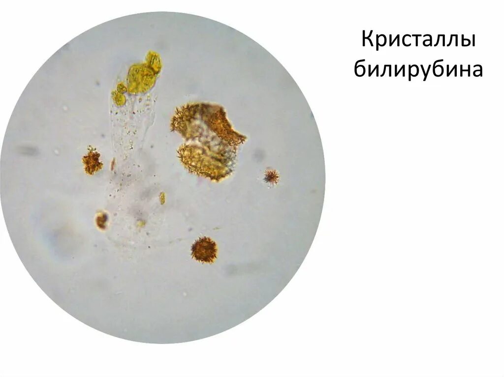 Микроскопия кала билирубин. Копрология микроскопия. Желчные пигменты в моче микроскопия. Билирубин в Кале микроскопия.