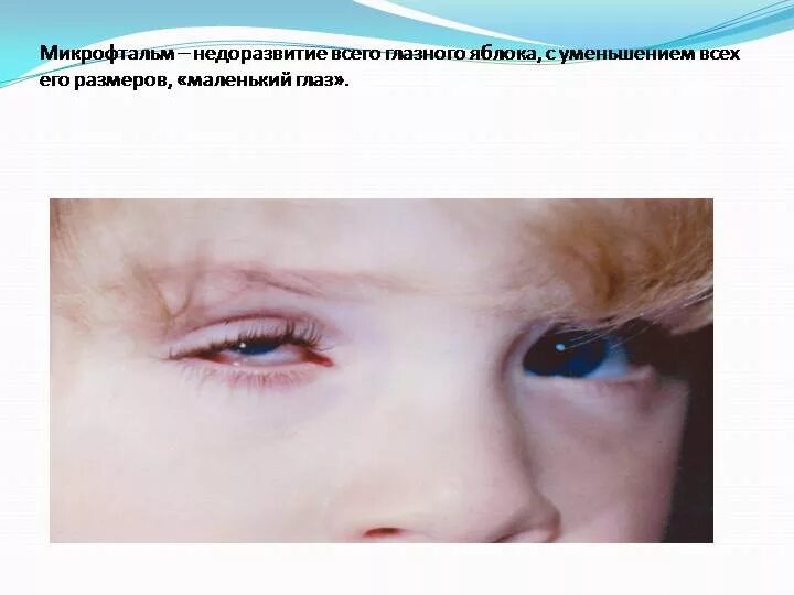 Анофтальм. Микрофтальм анофтальм. Блефарофимоз-птоз-эпикантус-синдром. Микрофтальм глаза у ребенка.