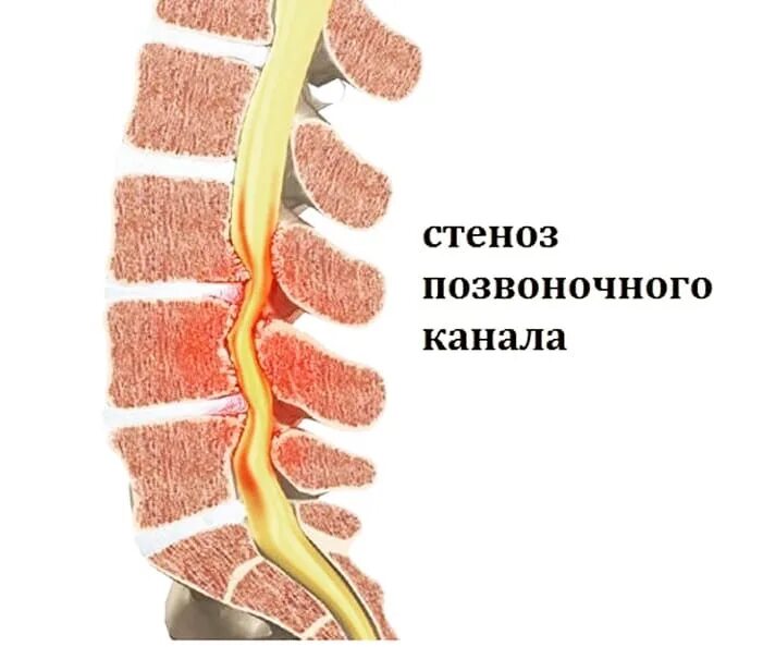 Фораминальный стеноз позвоночного канала. Комбинированный стеноз l3-l4. Дегенеративный спинальный стеноз l3-l4. Унковертебральный стеноз.