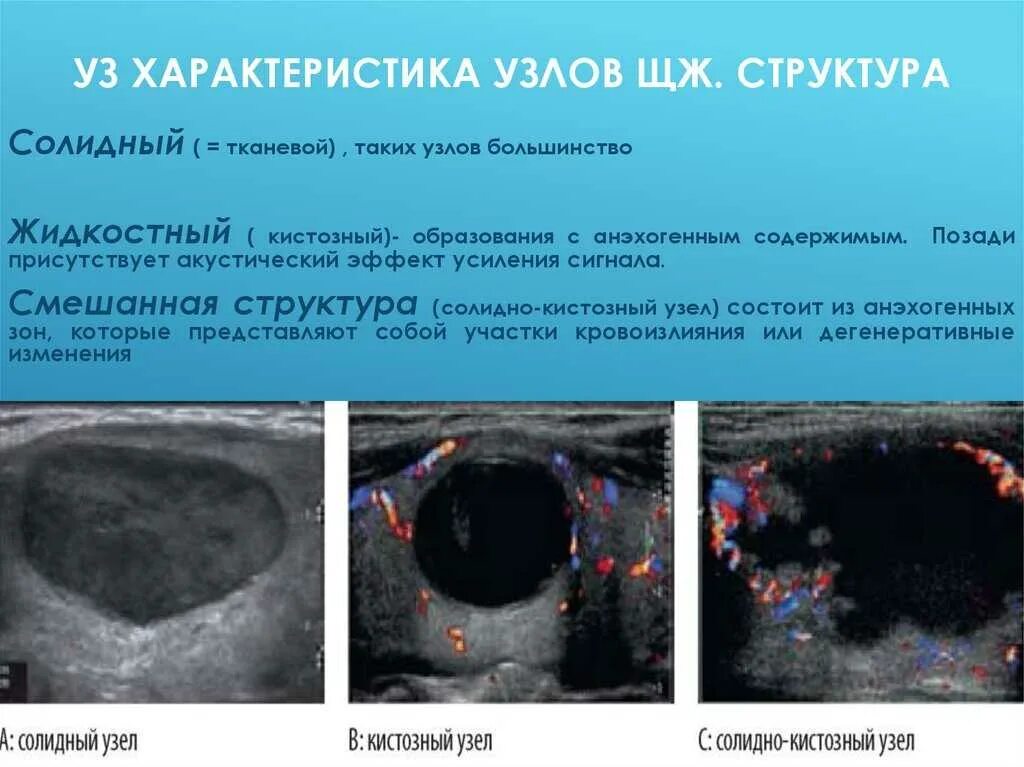 Кистозный солидный образование молочные железа. Солидное образование щитовидной железы по УЗИ. Солидное образование в щитовидной железе что это. Солидная структура узла щитовидной железы. Солидный узел в щитовидной железе.