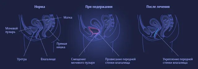 Непроизвольное Мочеиспускание У Женщин Во Время Секса