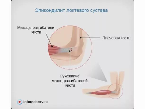 Точки акупунктуры при эпикондилите локтевого сустава. Медиальный эпикондилит сухожилия. Таблетки от эпикондилита локтевого сустава. Внешний эпикондилит локтевого сустава симптомы. Бандаж при эпикондилите ep-20a.