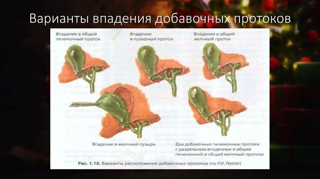 Топографическая анатомия внепеченочных желчных протоков. Расширение печеночного протока. Расширение печеночного протока. Расширение печеночного протока. Конкременты общего печеночного протока.