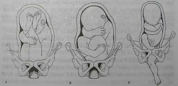 Тазовое ножное предлежание плода. Предлежание плода при беременности тазовое. Ягодичное предлежание плода УЗИ. Тазовое предлежание 36-37 недель беременности. 37 недель тазовое