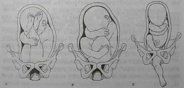 Тазовое предлежание плода на 20. Тазовое ножное предлежание плода. Предлежание плода при беременности тазовое. Ягодичное предлежание плода УЗИ. Тазовое предлежание 36-37 недель беременности.