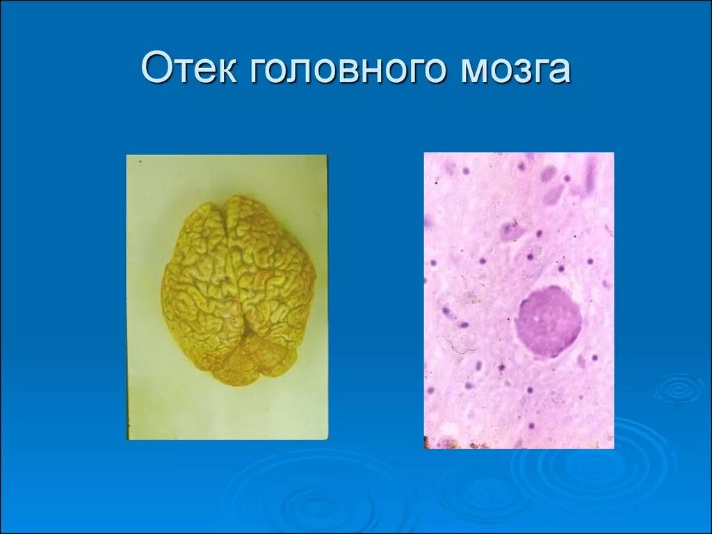 Отек набухание головного мозга. Отек и набухание вещества головного мозга.