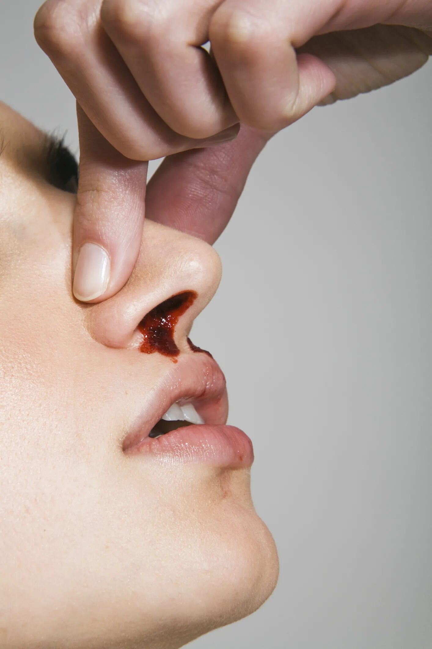 Идет кровь из носа с одной ноздри. Нососовое кровотечение. Эпистаксис – носовое кровотечение..
