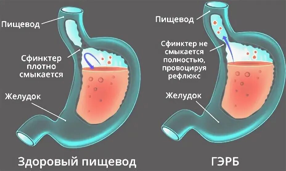 Желчь в желудке лекарства. Заброс желчи в желудок причины. Желчная кислота в желудке. Желчь в желудке причины. Вода из желудка уходит