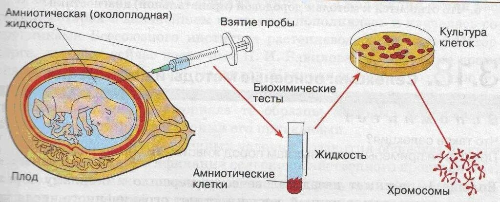 Схема биохимического метода диагностики генного заболевания. Биохимические методы диагностики состояния плода:. Забор околоплодных вод для хромосомного анализа. Методы исследования околоплодных вод.