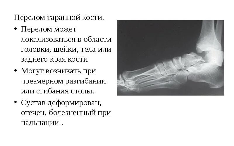 Смещение сустава стопы