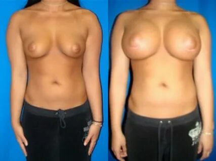 Slideshow prosthetic tits.