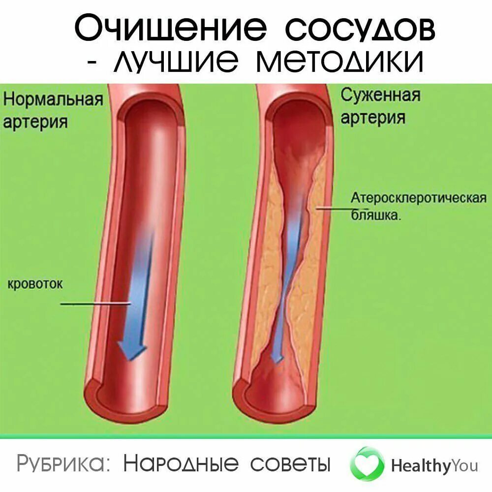 От бляшек и тромбов как очистить