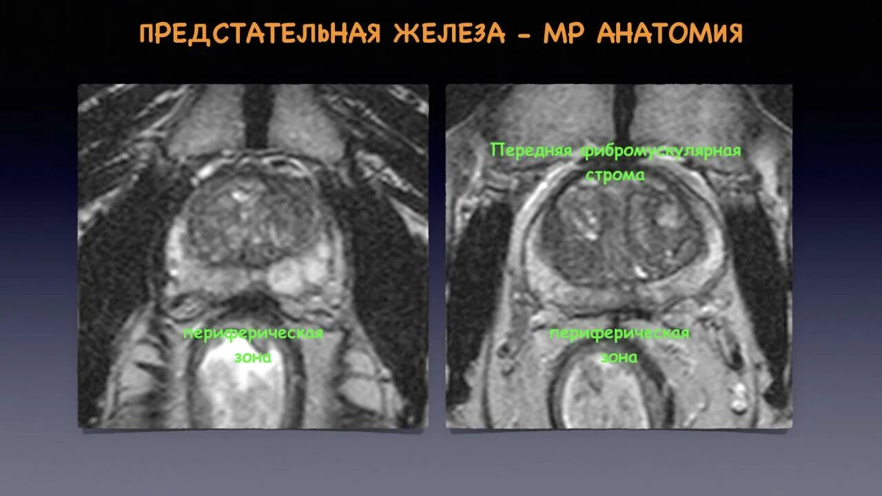 Pirads мрт. Аденокарцинома предстательной железы мрт. Зональное строение предстательной железы мрт. Аденома простаты мрт