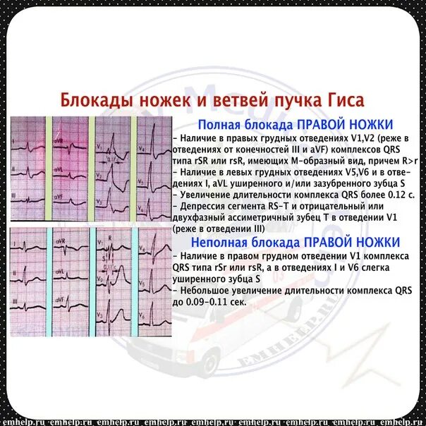 Частичная блокада ножки пучка гиса