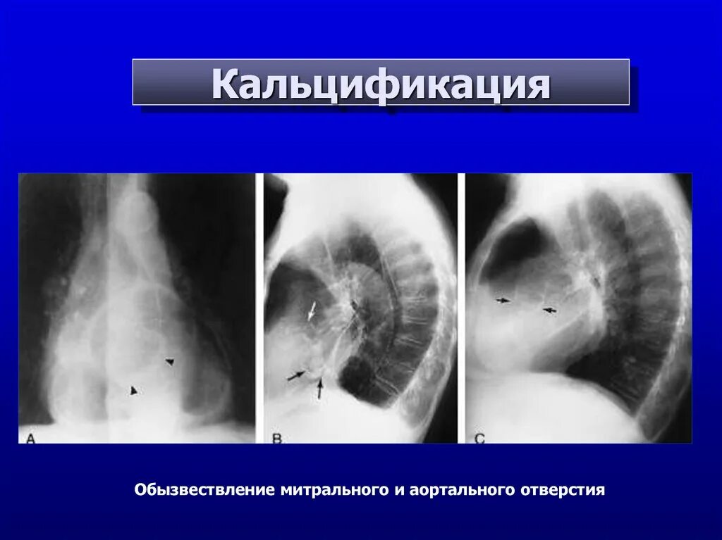 Кальциноз митрального клапана. Кальциноз митрального кольца. Метастатическая кальцификация. Кальцификация клапанов.