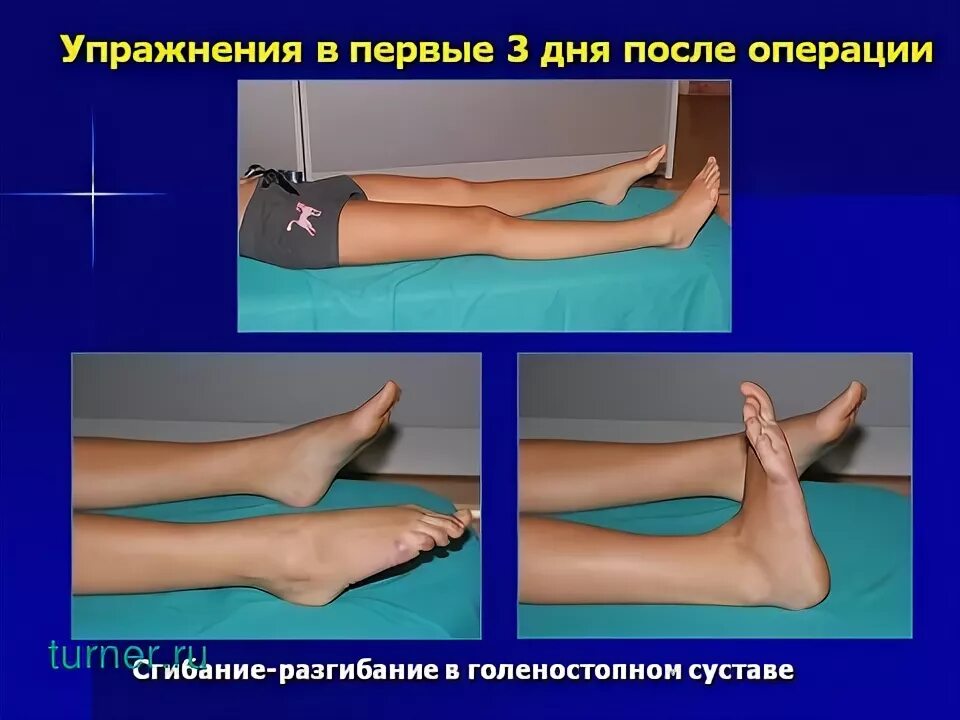Контрактура после эндопротезирования. Контрактура голеностопного сустава лечебная физкультура. сгибание и разгибание в голеностопном суставе.