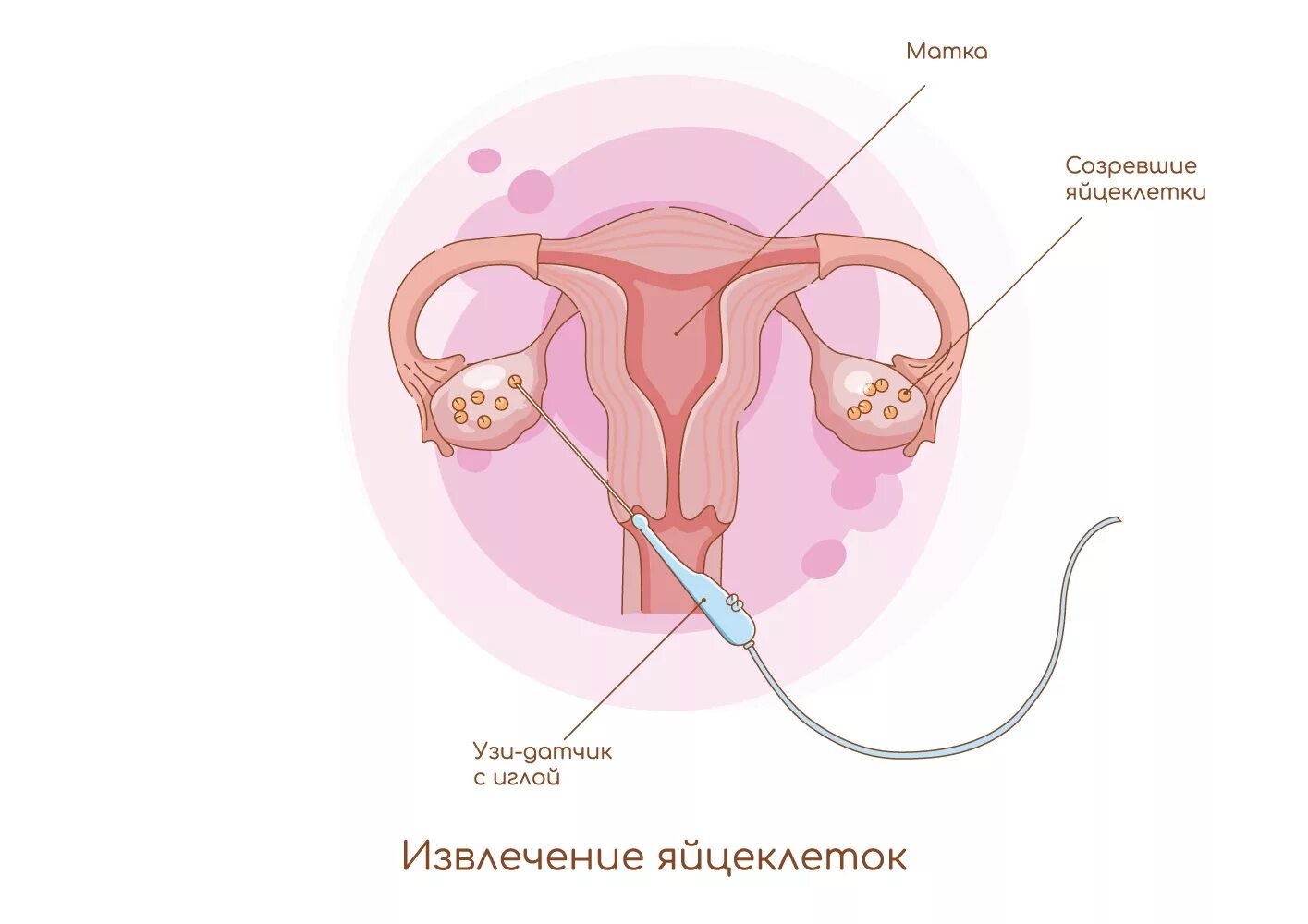 Как берут яйцеклетку для эко. Извлечение яйцеклетки для эко. забор яйцеклеток. извлечение яйцеклетки.