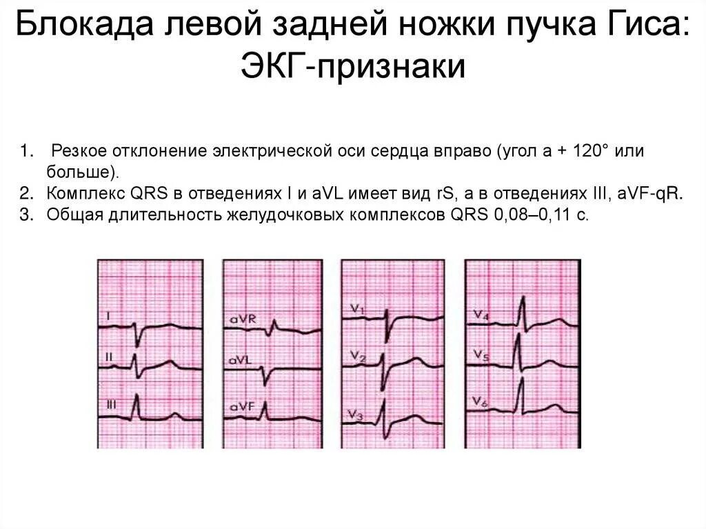 Левая ножка п гиса. ЭКГ при блокаде левой ножки пучка Гиса. Блокада левой ножки пучка Гиса на ЭКГ. Блокады ветвей пучка Гиса на ЭКГ. ЭКГ признаки блокады левой ножки пучка.