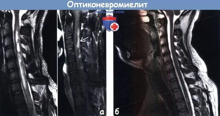 Оптикомиелит девика мрт. Заболевание спектра оптиконевромиелита. Оптиконевромиелит патогенез. Заболевание спектра оптиконевромиелита. Заболевание спектра оптиконевромиелита.