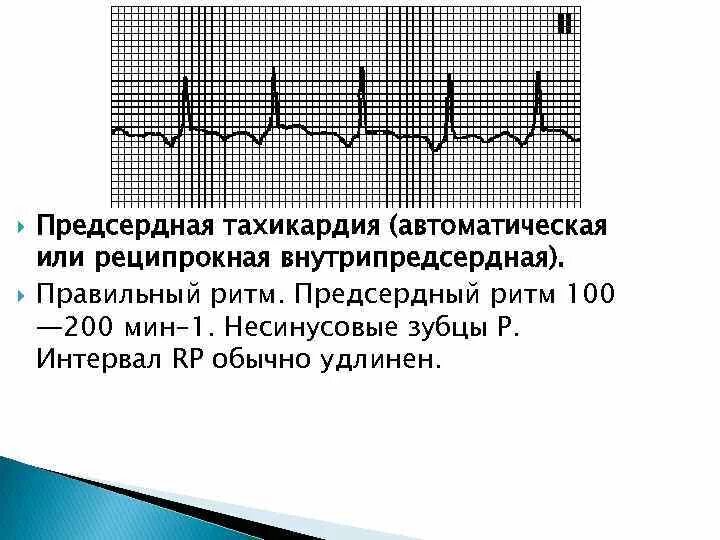 Предсердная блокада. Предсердная пароксизмальная тахикардия на ЭКГ. Предсердная пароксизмальная тахикардия с АВ блокадой 2 степени ЭКГ. Предсердная тахикардия с АВ блокадой 1 степени. Тахикардия предсердий на ЭКГ.