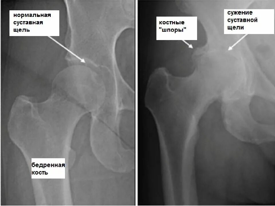 Степени коксартроза тазобедренного сустава рентген. Коксартроз 1 степени рентген. Коксартроз тазобедренного сустава рентген степени. Рентген коксартроза тазобедренного сустава 1 степени. Операция тазобедренного сустава 1 степени