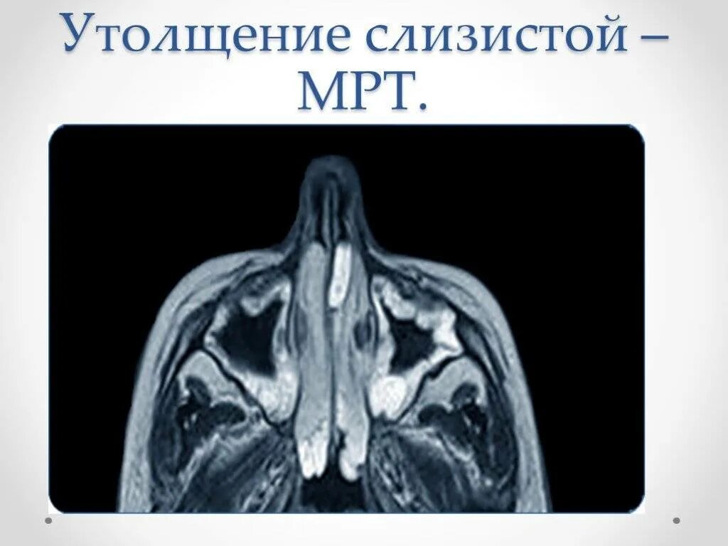 Пристеночный отек слизистой. Полипозный синусит мрт. Утолщение слизистой верхнечелюстной пазухи на кт. Гипертрофия гайморовой пазухи что такое. Утолщение слизистой оболочки носа.