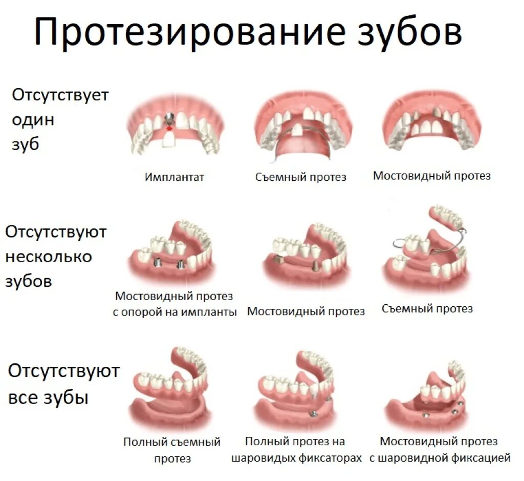 Снимать ли зубные протезы на ночь. Классификация съемных протезов. Классификация несъемных протезов ортопедическая стоматология. Какие виды съемных протезов бывают. Виды съемных конструкций зубных протезов.