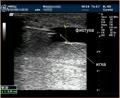 Узи фистулы
