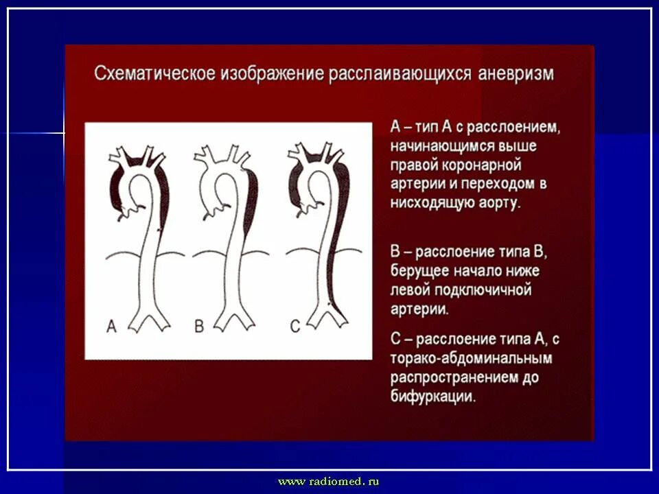 Расслаивающаяся аневризма аорты. Расслаивающаяся аневризма аорты