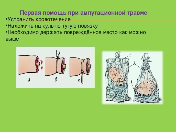 Действия при травматической ампутации. Первая помощь при травматической ампутации. Травматическая ампутация конечности. Первая помощь при травматической ампутации конечностей. Первая помощь при ранении стеклом.