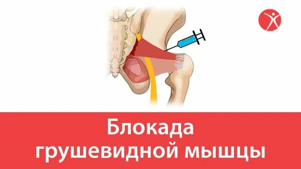 Блокада при защемлении седалищного нерва. Блокада грушевидной мышцы техника. Укол в грушевидную мышцу. Синдром грушевидной мышцы блокада. Блокада при грушевидной мышцы.