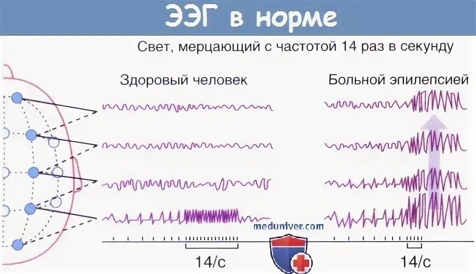 Сколько по времени длится ээг. Ээг нормальные показатели у ребенка. ээг норма заключение у взрослого головного. расшифровка показателей электроэнцефалограммы ээг головного мозга. норма ээг у детей 7 лет.