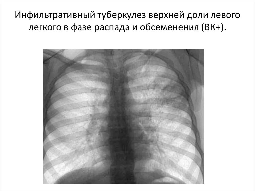 Инфильтративный распад легких