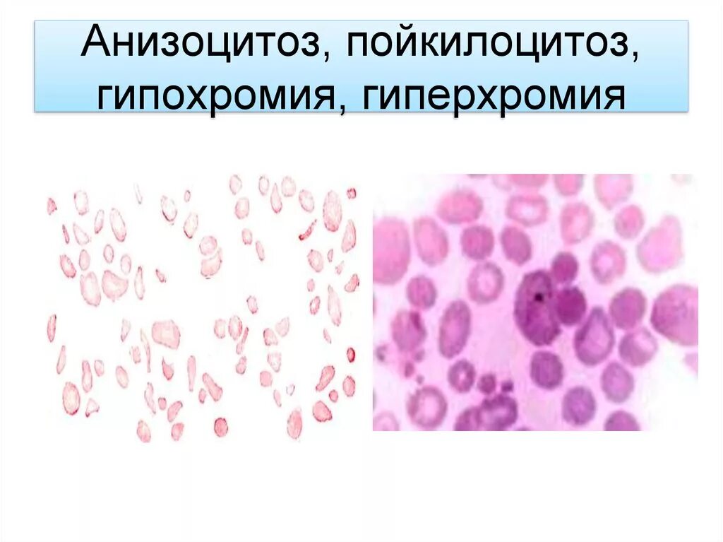 Пойкилоцитоз анемия. Гипохромия и гиперхромия. Анизоцитоз пойкилоцитоз гипохромия. Анизоцитоз пойкилоцитоз анизохромия. Пойкилоцитоз анизоцитоз анемия.