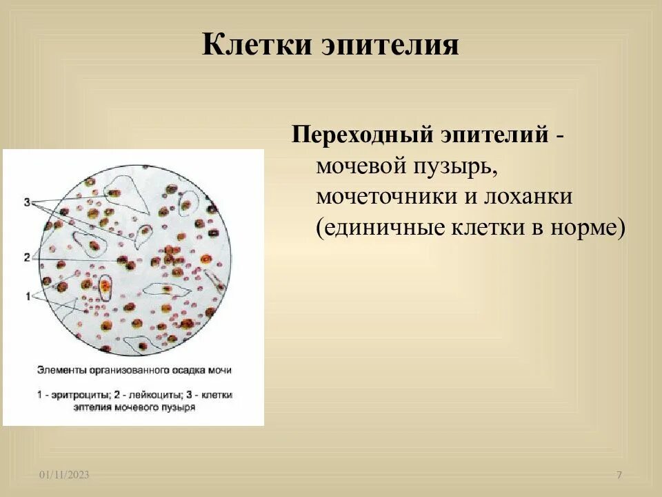 Апокринные клетки молочной железы. Цитология при дисплазии. Единичные клетки что это. Единичные клетки что это. Опухолевых клеток в спинномозговой жидкости.