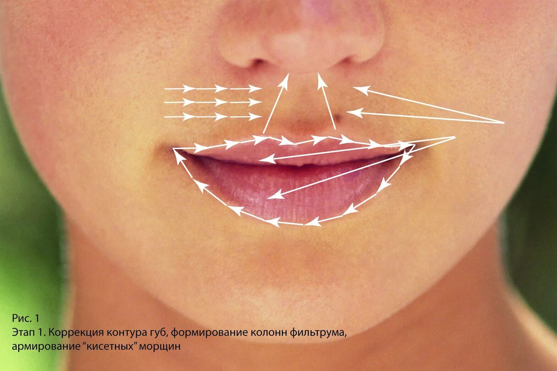 Подтяжка рта. Методика введения филлера в губы. Коррекция губ. Техника введения филлера в губы.