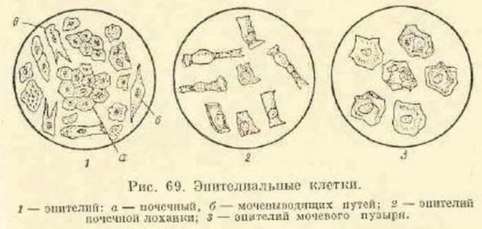 Эпителиальные клетки в моче микроскопия. Плоский эпителий микроскопия мочевого осадка. Плоский эпителий в моче микроскопия. Микроскопия мочи почечный эпителий. Повышенный эпителий в моче у мужчин