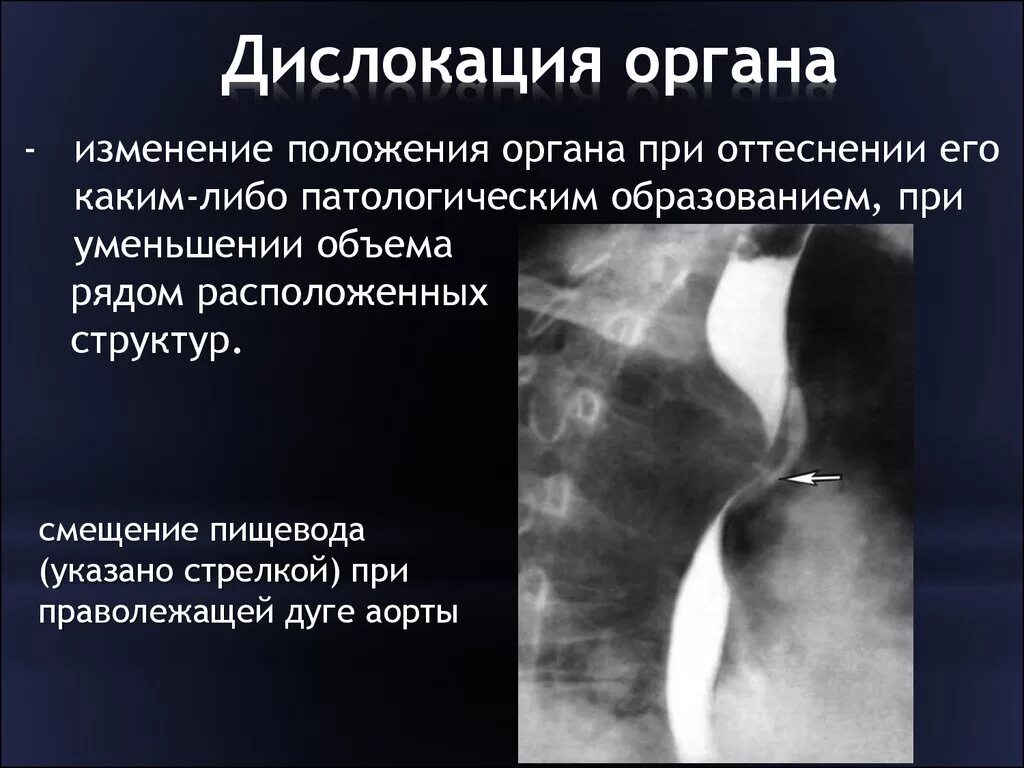 Синдром дислокации органа ЖКТ. Рентгенодиагностика заболеваний желудка. Синдром пищевода