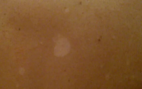 Посттравматическое витилиго. Белые пятна земли. Материковые острова гренландия. «белое пятно» размером с половину европы. Остров гренландия из космоса.