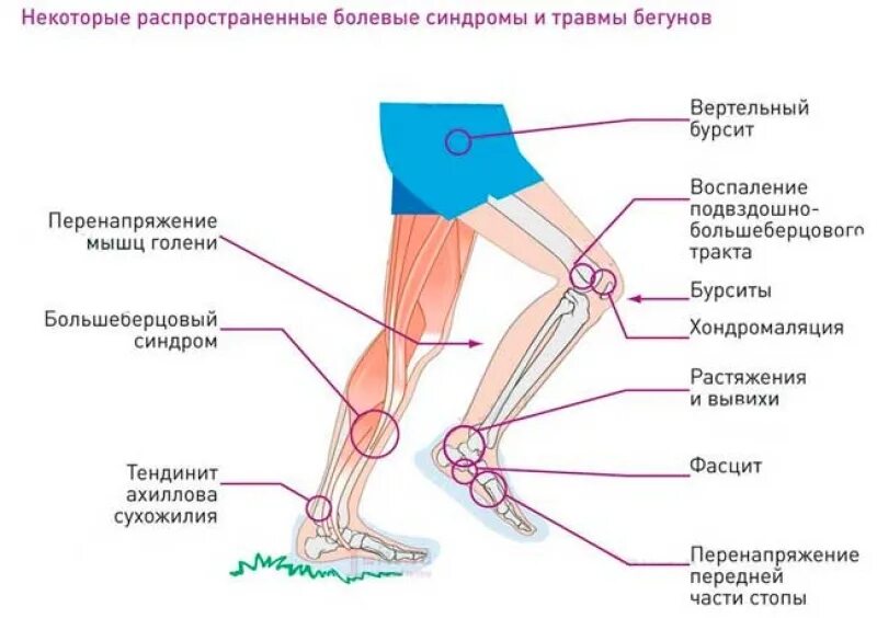 Боль в ногах от бедра до стопы. Синдром трения илиотибиального тракта. Ноет нога ниже колена сбоку с внешней стороны. Болит голень сбоку с внешней стороны.