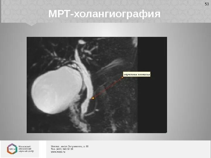 Холангиография желчевыводящих путей. Мрт желчных протоков холангиография. Холангиопанкреатография мрт.