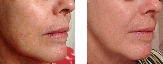 Омоложение сосудов