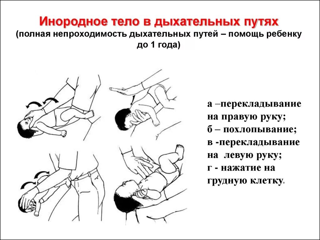 Первая помощь при попадании в глотку. Алгоритм оказания первой помощи при аспирации инородного тела. Оказание первой помощи при попадании инородного тела в дыхательные. Первая помощь при попадании постороннего предмета в дыхательные пути. Оказание первой при попадания инородного тела в дыхательные пути.