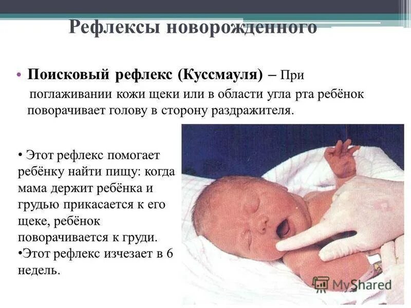 Куссмауля рефлекс у новорожденного. Ладонно-ротовой рефлекс Бабкина. Поисковый рефлекс Куссмауля. Рефлексы новорожденных детей.