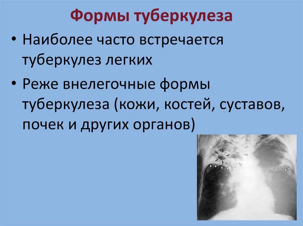 Туберкулез биология. Легочные формы туберкулеза. Легкие формы туберкулеза.