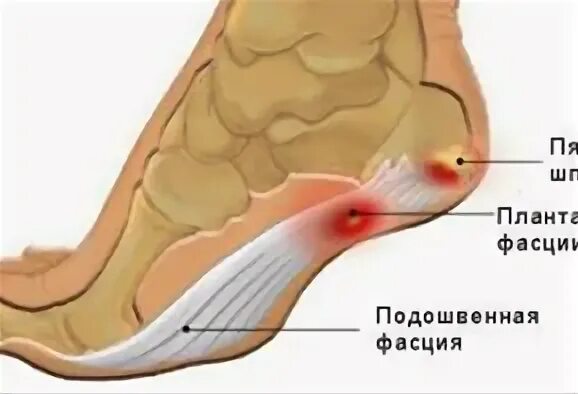Пяточная шпора проходит сама по себе. Пяточная шпора проходит сама по себе