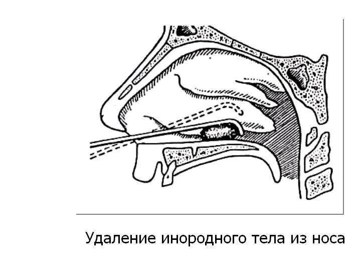 Удаление инородного предмета. Методика удаления инородных тел полости носа. инородные тела носовой полости извлечение. техника удаления инородного тела из полости носа. как достать инородное тело из носа.